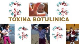 Toxina Botulinica, Síndrome de Angelman, Apadrina un Ángel