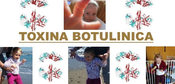 Toxina Botulinica, Síndrome de Angelman, Apadrina un Ángel